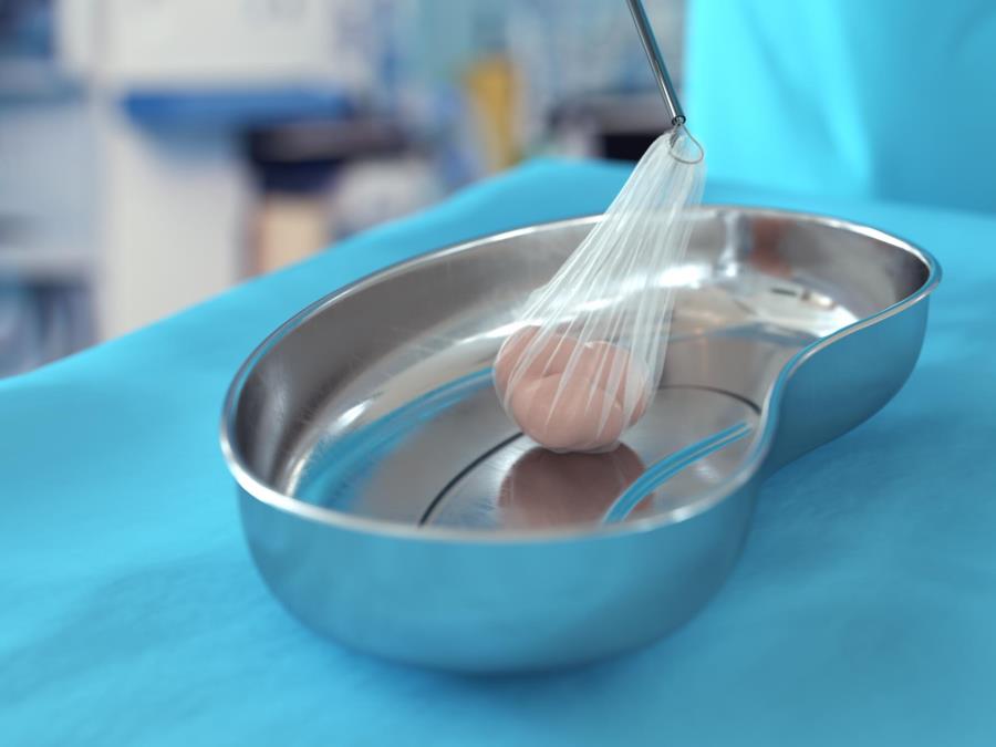 Specimen in retrieval bag being disposed in metallic bowl